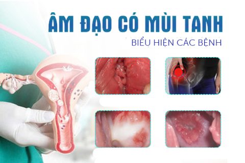 Âm đạo có mùi hôi là biểu hiện của bệnh gì