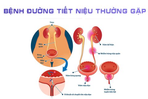 Bệnh đường tiết niệu thường gặp là bệnh gì