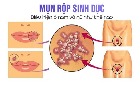 Biểu hiện mụn rộp sinh dục ở nam và nữ như thế nào