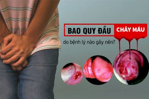 Chảy máu bao quy đầu do bệnh lý nào gây nên