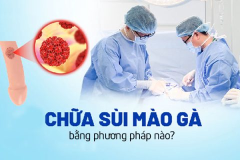 Chữa trị sùi mào gà bằng phương pháp nào