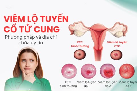 Chữa trị viêm cổ tử cung Phương pháp và địa chỉ uy tín