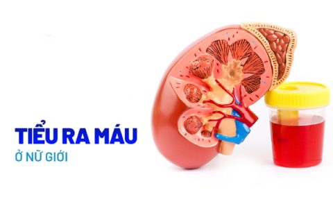 Đi tiểu ra máu ở nữ