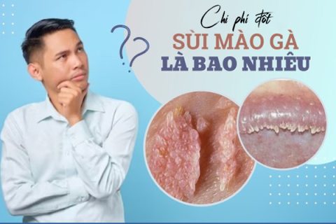 Đốt sùi mào gà và chi phí bao nhiêu