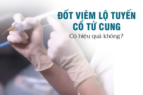Đốt viêm lộ tuyến có hiệu quả không