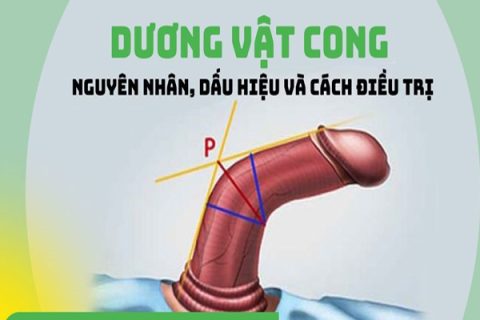 Dương vật bị cong là gì Khắc phục tình trạng dương vật cong hiệu quả