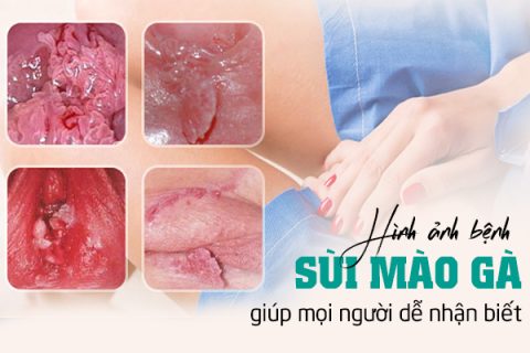 Hình ảnh sùi mào gà giúp mọi người dễ nhận biết