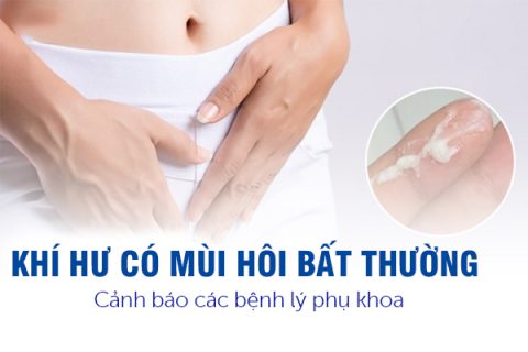 Khí hư có mùi hôi bất thường Cảnh báo các bệnh lý phụ khoa