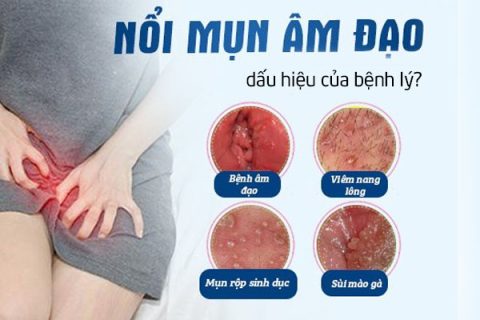 Mụn âm đạo là dấu hiệu bệnh lý gì
