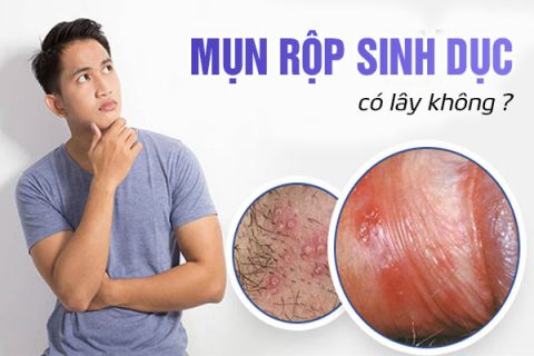 Mụn rộp sinh dục có lây không