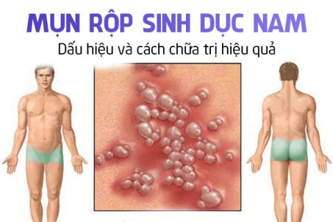 Mụn rộp sinh dục nam Dấu hiệu và cách chữa trị hiệu quả