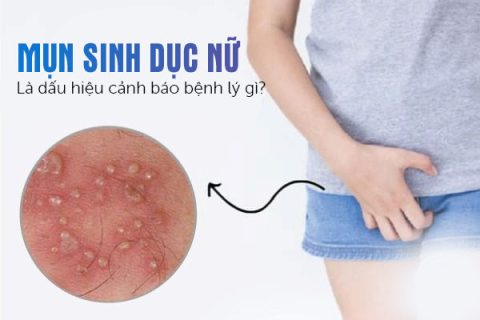 Mụn sinh dục nữ là dấu hiệu cảnh báo bệnh lý gì