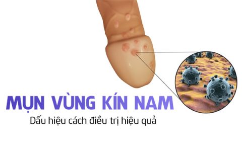 Mụn vùng kín nam Dấu hiệu cách điều trị hiệu quả