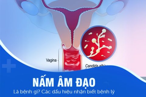 Nấm âm đạo là bệnh gì Các dấu hiệu nhận biết bệnh lý
