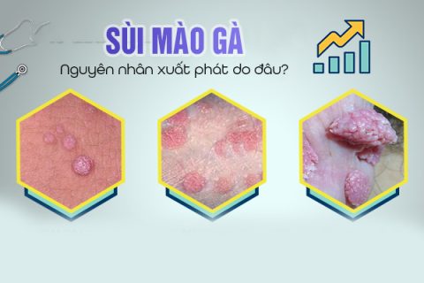 Nguyên nhân sùi mào gà xuất phát do đâu