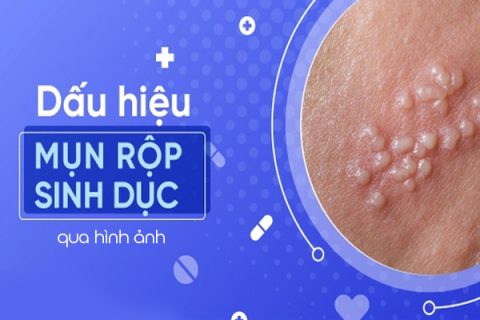 Nhận biết dấu hiệu mụn rộp sinh dục qua hình ảnh