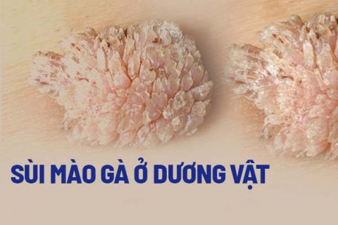 Nhận biết sùi mào gà ở dương vật ảnh