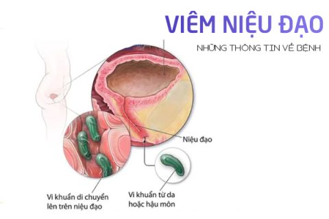 Những thông tin về viêm niệu đạo ở nữ