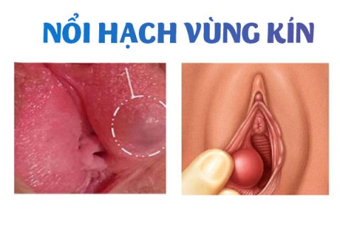 Nổi hạch vùng kín là bệnh gì
