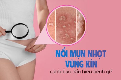 Nổi mụn nhọt vùng kín cảnh báo dấu hiệu bệnh gì