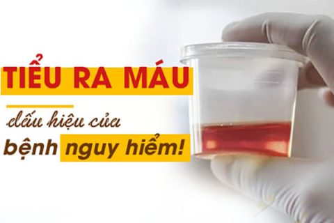 Tiểu ra máu cảnh báo bệnh lý nguy hiểm nào