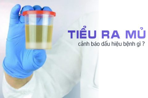 Tiểu ra mủ cảnh báo dấu hiệu bệnh gì