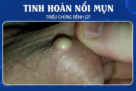 Tinh hoàn nổi mụn là triệu chứng bệnh gì