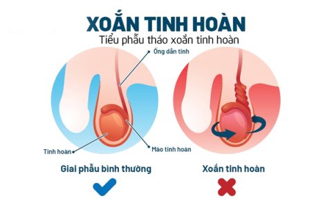 Xoắn tinh hoàn là gì Tiểu phẫu tháo xoắn tinh hoàn